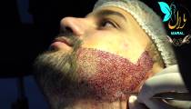 کاشت ریش | فیلم کاشت ریش | کلینیک پوست و مو مارال | شماره 1