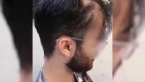 علت عدم موفقیت کاشت مو