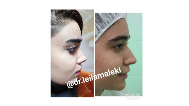 نمونه کار جراحی بینی 2