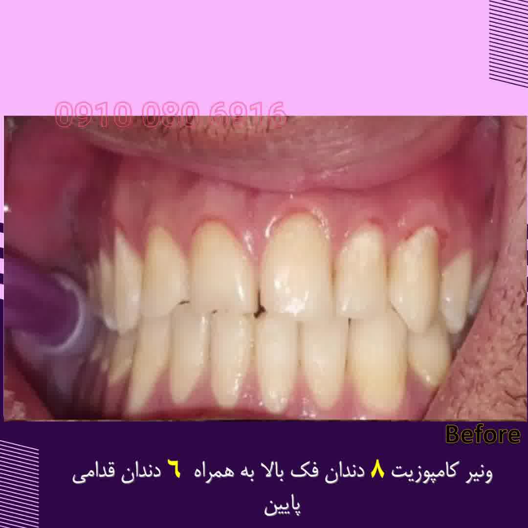 انجام ونیر کامپوزیت چهارده دندان برای زیباجوی عزیز