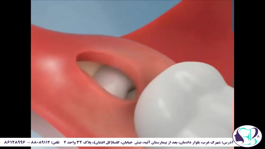 فیلم کامل کشیدن دندان عقل